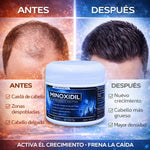 MINOXIDIL – SOLUCIÓN PARA EL CRECIMIENTO CAPILAR